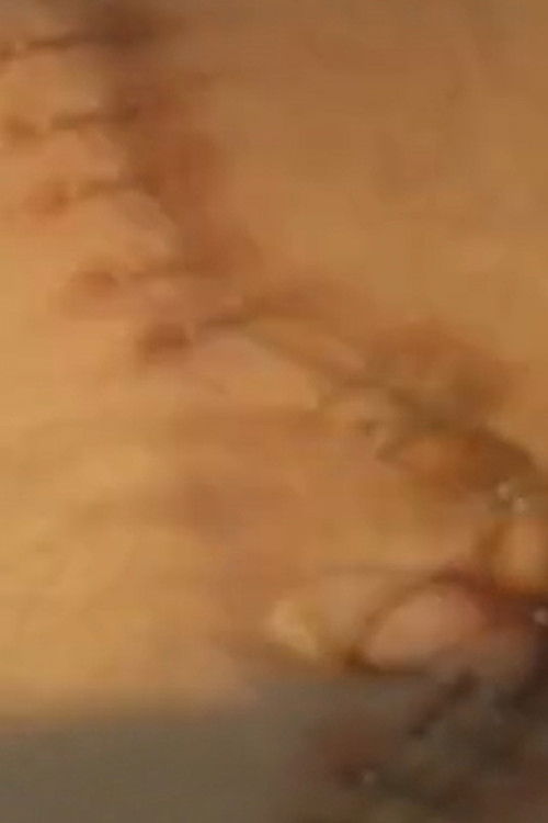 Suite: Double Nephrectomy (1998) poster